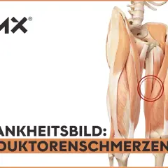 Anatomische Darstellung der Oberschenkelmuskulatur mit Hervorhebung des Adduktorenmuskels, der Schmerzen verursacht.