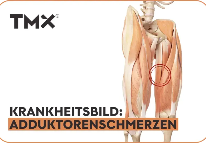 Anatomische Darstellung der Oberschenkelmuskulatur mit Hervorhebung des Adduktorenmuskels, der Schmerzen verursacht.
