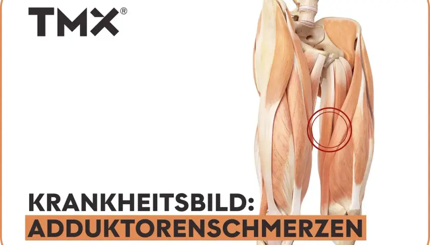 Anatomische Darstellung der Oberschenkelmuskulatur mit Hervorhebung des Adduktorenmuskels, der Schmerzen verursacht.