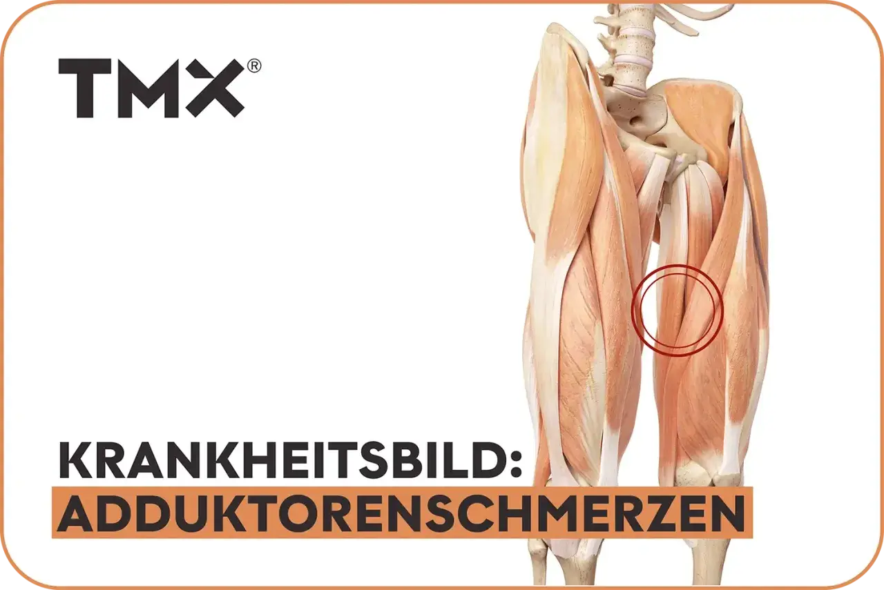 Anatomische Darstellung der Oberschenkelmuskulatur mit Hervorhebung des Adduktorenmuskels, der Schmerzen verursacht.